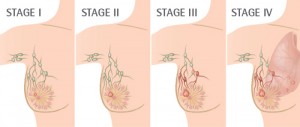 4 Giai đoạn ung thư vú