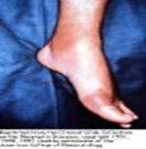 Bệnh gout - Nguyên nhân và triệu chứng